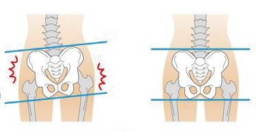 骨盤のゆがみ