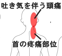 30代 女性 ムカムカした吐き気を伴う頭痛 症例 しゅはら鍼灸整骨院 京都府亀岡市千代川町