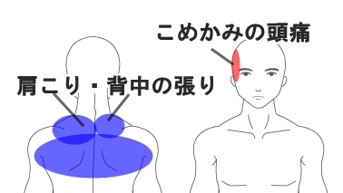 30代 男性 会社員 右こめかみの頭痛 症例 しゅはら鍼灸整骨院 京都府亀岡市千代川町