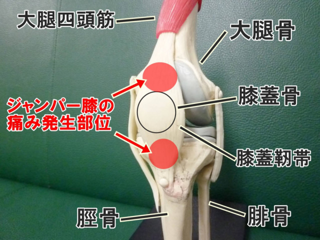 ジャンパー膝 膝蓋腱炎 しゅはら鍼灸整骨院 京都府亀岡市千代川町